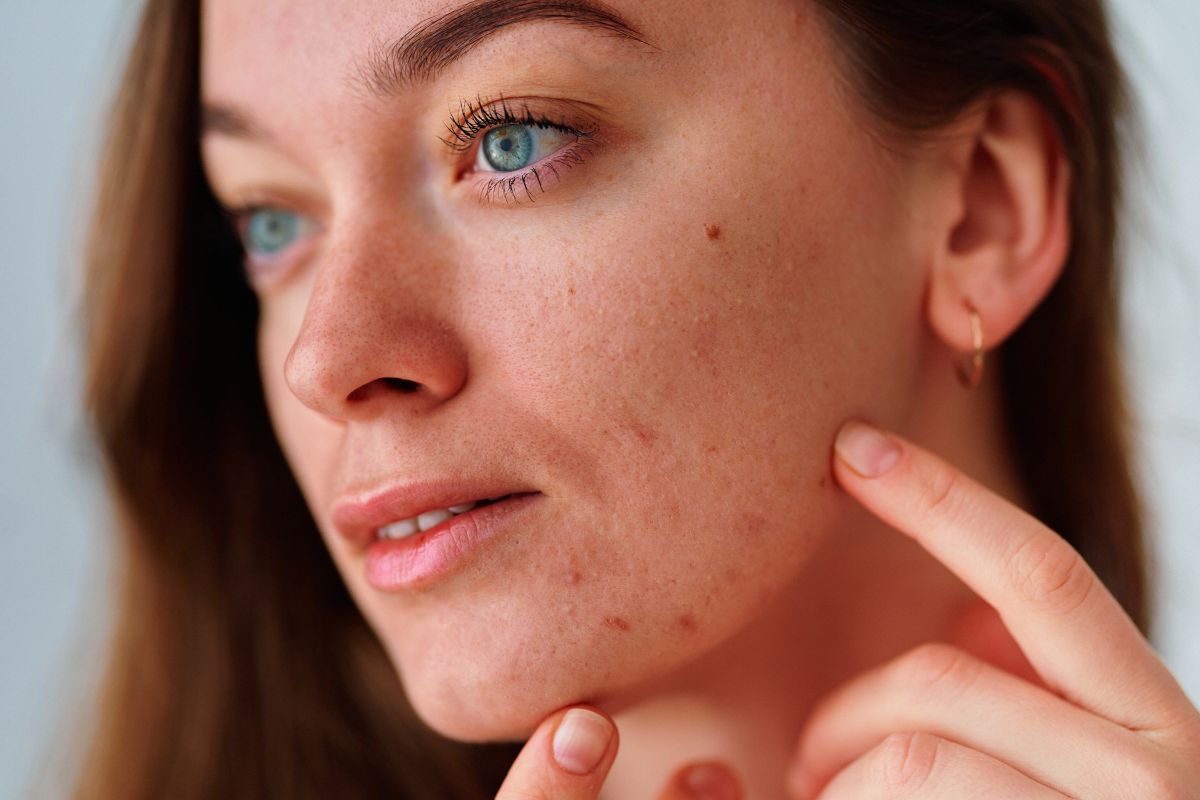 Cinco beneficios del aloe vera para combatir el acné