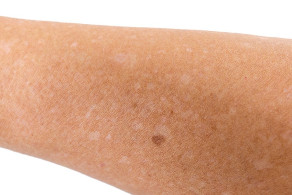 Qué las manchas blancas en piel? | Aloe Plus