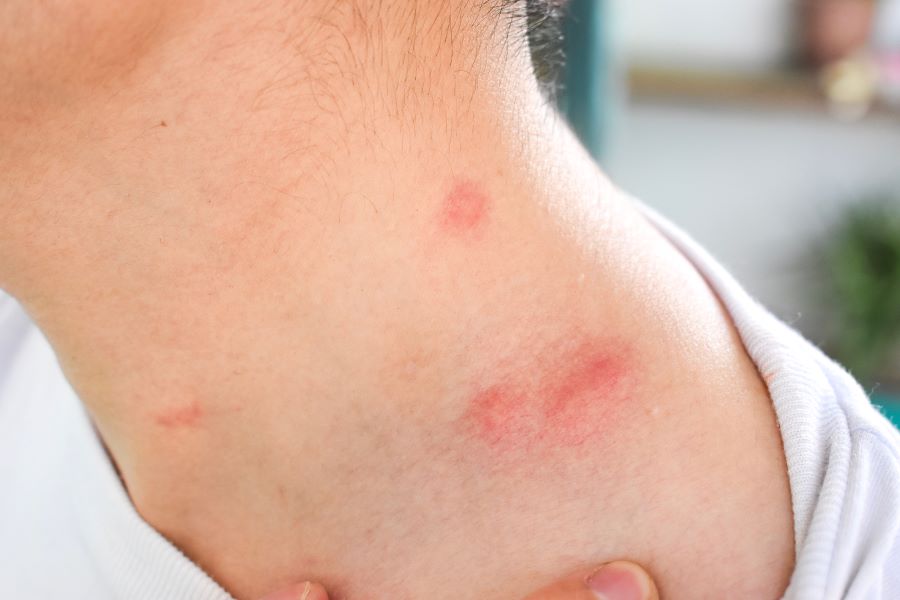 ▷ Tratar ronchas en la piel por alergia - Aloe Plus Lanzarote